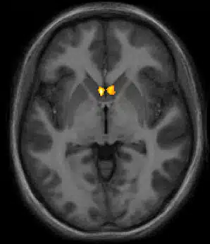  Zaljubljenost umanjuje bol aktivirajući primitivne moždane  strukture koje uključuju osjećaj ugode i  nagrade, kao što je to  nucleus accumbens- u boji prikazan na slici.